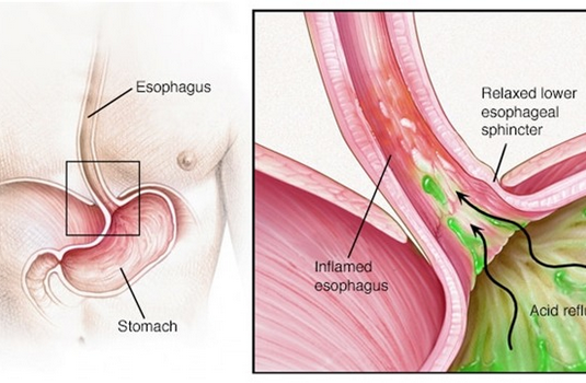 Gastroesophageal Reflux Disease Treatment In India Cost Hospitals